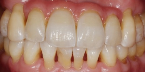 Close up of complete smile with dental implants