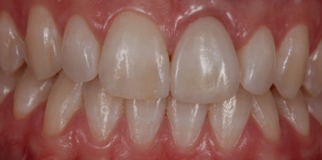 Close up of complete smile with dental implants