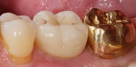 Close up of complete smile with dental implants