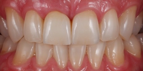 Close up of complete smile with dental implants