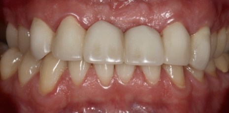 Close up of smile before getting dental implants