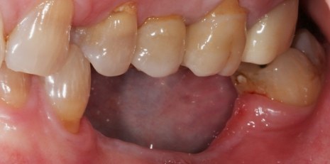 Close up of smile before getting dental implants