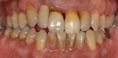 Close up of smile before getting dental implants