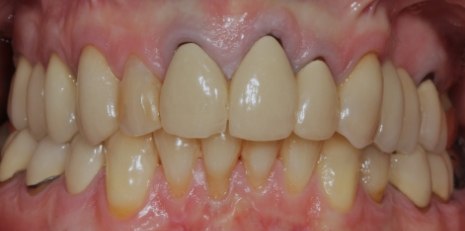 Close up of smile before getting dental implants