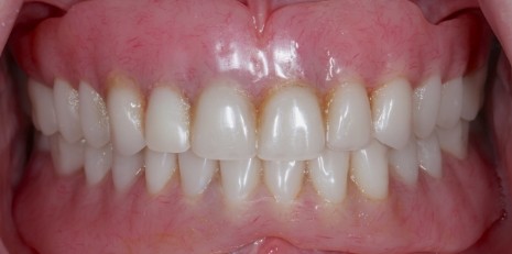 Close up of smile before getting dental implants