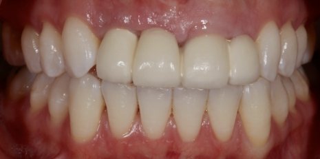 Close up of smile before getting dental implants