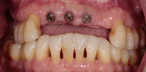 Close up of smile before getting dental implants