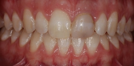 Close up of smile before getting dental implants