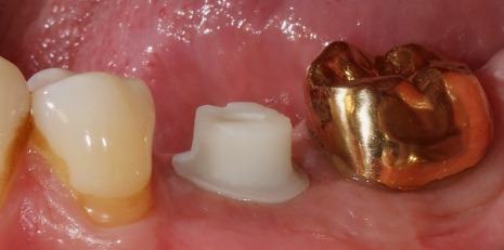 Close up of smile before getting dental implants