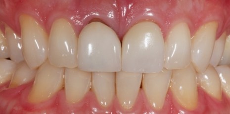 Close up of smile before getting dental implants