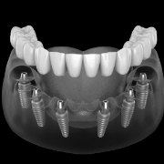 Illustrated full denture being placed onto six dental implants