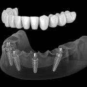 Illustrated full denture being placed onto four precisely angeled dental implants