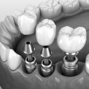Three illustrated dental crowns being placed onto three dental implants