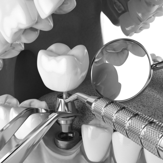 Illustrated model of dental implant being placed in the jaw