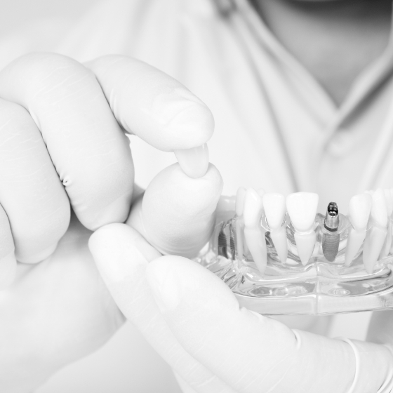 Dentist holding dental crown and model of mouth with dental implant