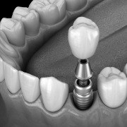 Illustrated dental crown being placed onto a dental implant