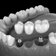 Illustrated dental bridge being placed onto two dental implants