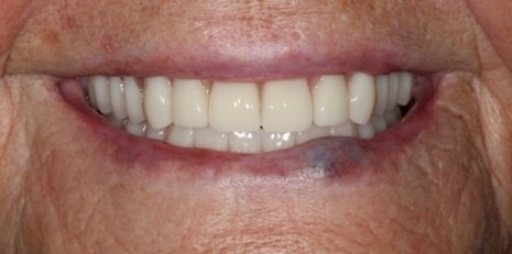 Close up of complete smile with dentures