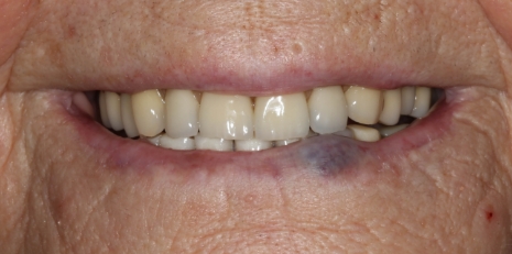 Close up of mouth with no teeth