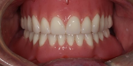 Close up of complete smile with dentures