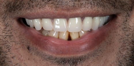Close up of complete smile with dentures