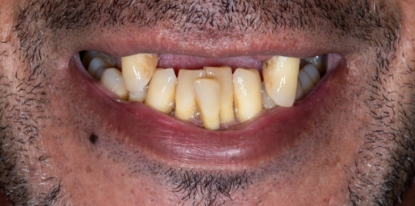 Close up of mouth with no teeth