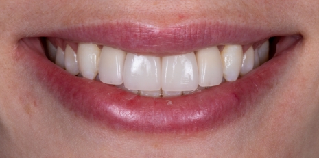 Close up of flawless teeth after full mouth reconstruction