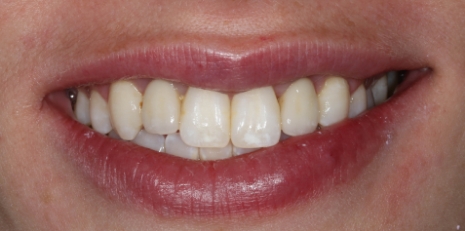 Close up of damaged smile before full mouth reconstruction