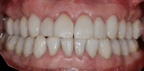 Close up of flawless teeth after full mouth reconstruction