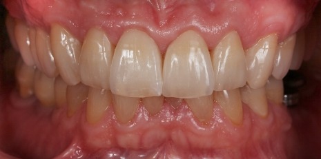 Close up of flawless teeth after full mouth reconstruction