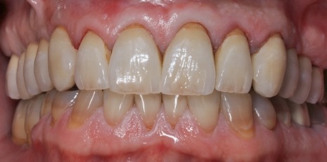 Close up of flawless teeth after full mouth reconstruction