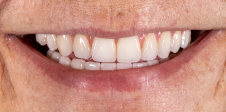 Close up of flawless teeth after full mouth reconstruction