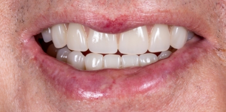 Close up of flawless teeth after full mouth reconstruction