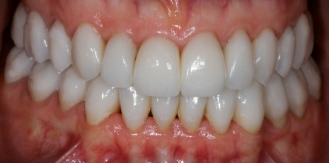 Close up of flawless teeth after full mouth reconstruction