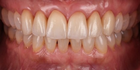 Close up of flawless teeth after full mouth reconstruction