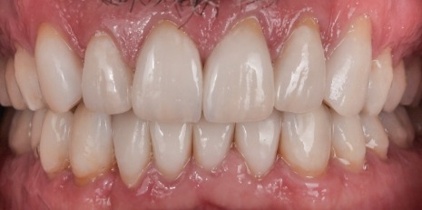 Close up of flawless teeth after full mouth reconstruction