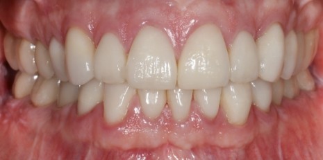 Close up of flawless teeth after full mouth reconstruction