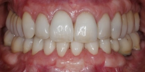 Close up of flawless teeth after full mouth reconstruction