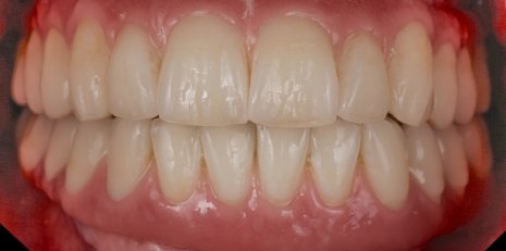 Close up of flawless teeth after full mouth reconstruction