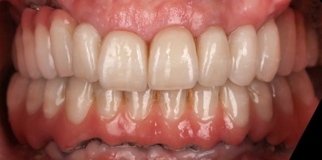 Close up of flawless teeth after full mouth reconstruction