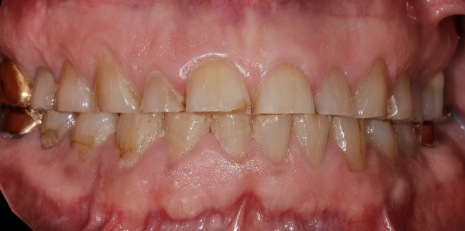 Close up of damaged smile before full mouth reconstruction