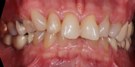 Close up of damaged smile before full mouth reconstruction