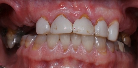 Close up of damaged smile before full mouth reconstruction