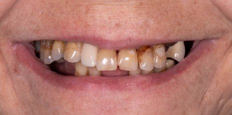 Close up of damaged smile before full mouth reconstruction