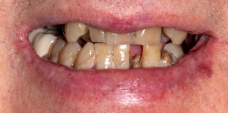 Close up of damaged smile before full mouth reconstruction