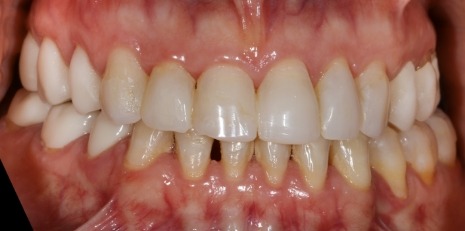 Close up of damaged smile before full mouth reconstruction