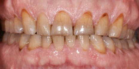 Close up of damaged smile before full mouth reconstruction