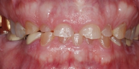Close up of damaged smile before full mouth reconstruction