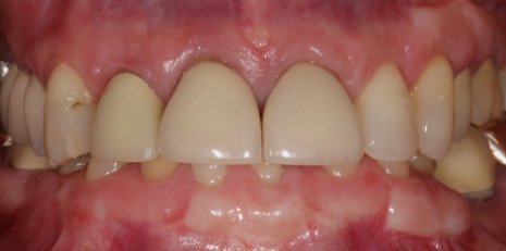 Close up of damaged smile before full mouth reconstruction