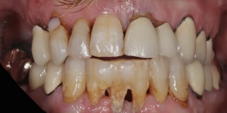 Close up of damaged smile before full mouth reconstruction